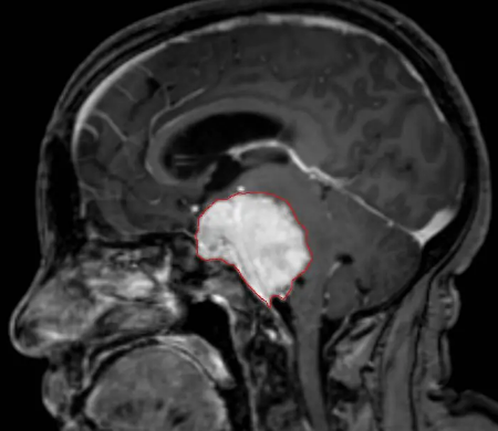 difference between meningioma and glioma