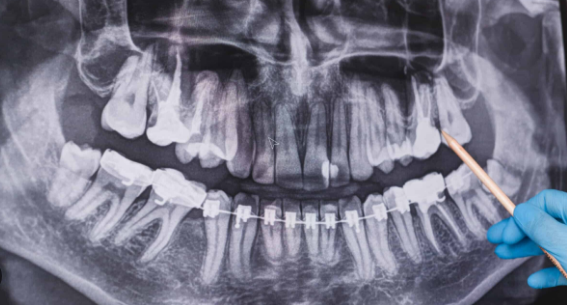 Demystifying Root Canal Infections