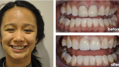 badly decayed teeth before and after