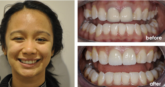 badly decayed teeth before and after