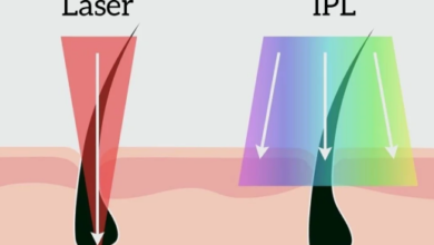What is the Difference Between IPL and Laser Treatment?